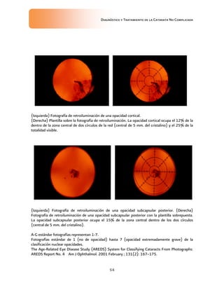 Diagnóstico y Tratamiento de la Catarata No Complicada
54
(Izquierda) Fotografía de retroiluminación de una opacidad cortical.
(Derecha) Plantilla sobre la fotografía de retroiluminación. La opacidad cortical ocupa el 12% de la
dentro de la zona central de dos círculos de la red (central de 5 mm. del cristalino) y el 25% de la
totalidad visible.
(Izquierda) Fotografía de retroiluminación de una opacidad subcapsular posterior. (Derecha)
Fotografía de retroiluminación de una opacidad subcapsular posterior con la plantilla sobrepuesta.
La opacidad subcapsular posterior ocupa el 15% de la zona central dentro de los dos círculos
(central de 5 mm. del cristalino).
A-G estándar fotografías representan 1-7.
Fotografías estándar de 1 (no de opacidad) hasta 7 (opacidad extremadamente grave) de la
clasificación nuclear opacidades.
The Age-Related Eye Disease Study (AREDS) System for Classifying Cataracts From Photographs:
AREDS Report No. 4 Am J Ophthalmol. 2001 February ; 131(2): 167–175.
 