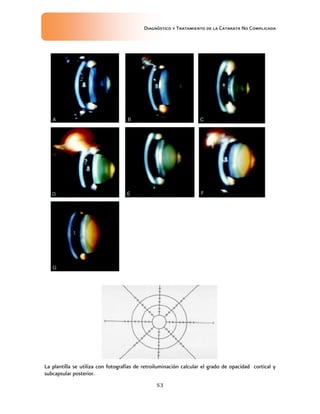 Diagnóstico y Tratamiento de la Catarata No Complicada
53
La plantilla se utiliza con fotografías de retroiluminación calcular el grado de opacidad cortical y
subcapsular posterior.
 