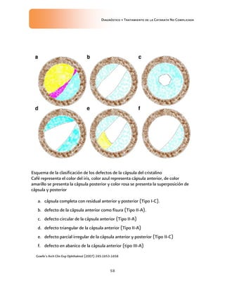 Diagnóstico y Tratamiento de la Catarata No Complicada
58
Esquema de la clasificación de los defectos de la cápsula del cristalino
Café representa el color del iris, color azul representa cápsula anterior, de color
amarillo se presenta la cápsula posterior y color rosa se presenta la superposición de
cápsula y posterior
a. cápsula completa con residual anterior y posterior (Tipo I-C).
b. defecto de la cápsula anterior como fisura (Tipo II-A).
c. defecto circular de la cápsula anterior (Tipo II-A)
d. defecto triangular de la cápsula anterior (Tipo II-A)
e. defecto parcial irregular de la cápsula anterior y posterior (Tipo II-C)
f. defecto en abanico de la cápsula anterior (tipo III-A)
Graefe’s Arch Clin Exp Ophthalmol (2007) 245:1653-1658
 