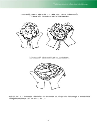 Vigilancia y manejo del trabajo de parto de bajo riesgo
19
Figuras 1 Exploración de la placenta posterior a su expulsión
Exploración de placenta en cara materna
Exploración de placenta en cara materna
Tomado de: FIGO Guidelines. Prevention and treatment of postpartum hemorrhage in low-resource
settings.Intern J of Gyn Obst.2012;117:108-118
 