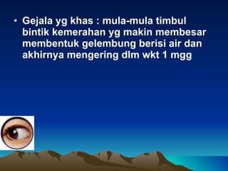 Gejala yg khas : mula-mula timbul bintik kemerahan yg makin membesar membentuk gelembung berisi air dan akhirnya mengering dlm wkt 1 mgg 