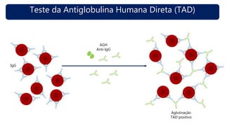 Teste da Antiglobulina Humana Direta (TAD)
AGH
Anti-IgG
Aglutinação
TAD positivo
IgG
 