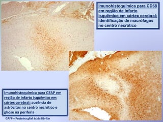 Imunohistoquímica para CD68
em região de infarto
isquêmico em córtex cerebral:
identificação de macrófagos
no centro necrótico
Imunohistoquímica para GFAP em
região de infarto isquêmico em
córtex cerebral: ausência de
astrócitos no centro necrótico e
gliose na periferia
GAFP = Proteína glial ácida fibrilar
 