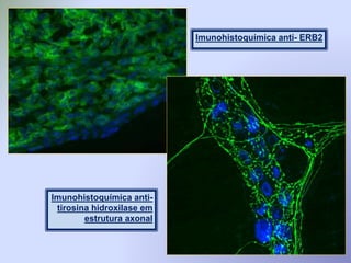 Imunohistoquímica anti- ERB2
Imunohistoquímica anti-
tirosina hidroxilase em
estrutura axonal
 