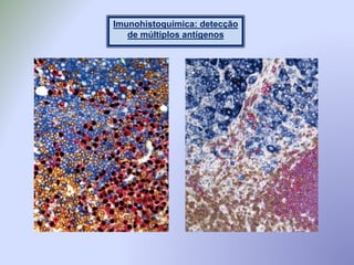 Imunohistoquímica: detecção
de múltiplos antígenos
 