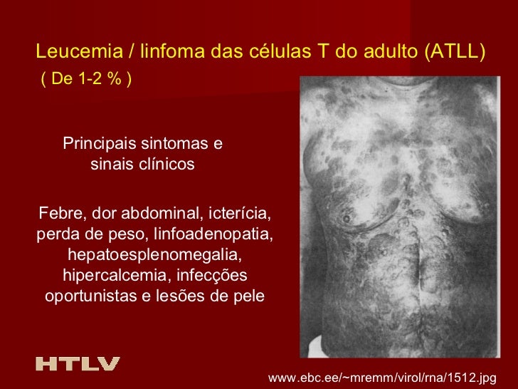 Resultado de imagem para Infecção pelo Vírus T-linfotrópico humano
