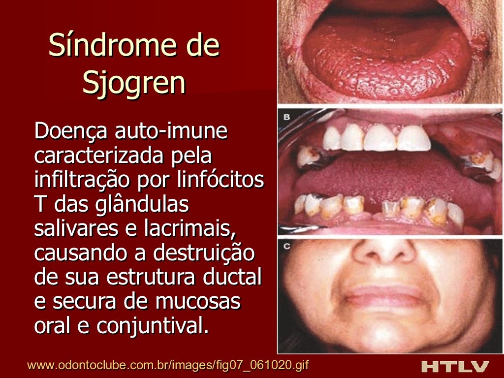 HTLV - Vírus linfotrópico de células T humano