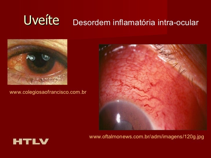 HTLV - Vírus linfotrópico de células T humano