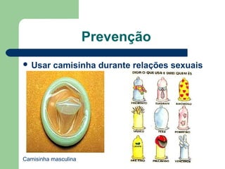 Prevenção
 Usar

camisinha durante relações sexuais

Camisinha masculina

 