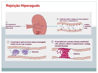 Rejeição Hiperaguda
 