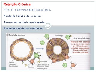 Rejeição Crônica
Fi brose e anorm al i dade vascul ares.
P erda de funç ão do enxerto.
Ocorre em perí odo prol ongado.
E nxertos renai s ou cardí acos.
 