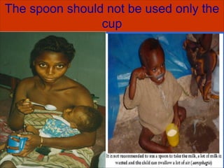 In-patient Rx of Sever acuate Malnutrition | PDF