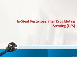 In-Stent Restenosis after Drug Eluting
Stenting (DES)
 