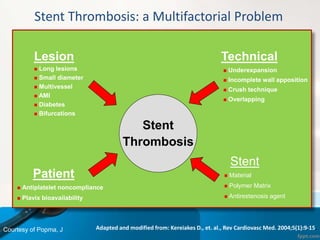 Lesion
 Long lesions
 Small diameter
 Multivessel
 AMI
 Diabetes
 Bifurcations
Technical
 Underexpansion
 Incomplete wall apposition
 Crush technique
 Overlapping
Patient
 Antiplatelet noncompliance
 Plavix bioavailability
Stent
 Material
 Polymer Matrix
 Antirestenosis agent
Stent Thrombosis: a Multifactorial Problem
Adapted and modified from: Kereiakes D., et. al., Rev Cardiovasc Med. 2004;5(1):9-15.
Stent
Thrombosis
Courtesy of Popma, J
 