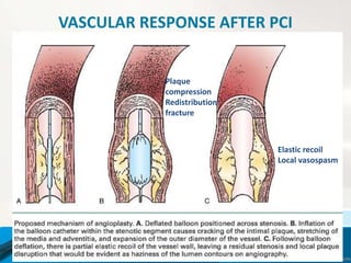 VASCULAR RESPONSE AFTER PCI
Plaque
compression
Redistribution
fracture
Elastic recoil
Local vasospasm
 