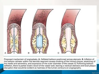 Plain Old Balloon Angioplasty (POBA)
 Dissections – Focal to threatened dissection
 Acute recoil
 Chronic constrictive remodeling
 