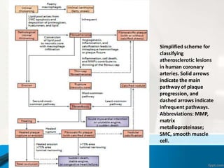 Simplified scheme for
classifying
atherosclerotic lesions
in human coronary
arteries. Solid arrows
indicate the main
pathway of plaque
progression, and
dashed arrows indicate
infrequent pathways.
Abbreviations: MMP,
matrix
metalloproteinase;
SMC, smooth muscle
cell.
 
