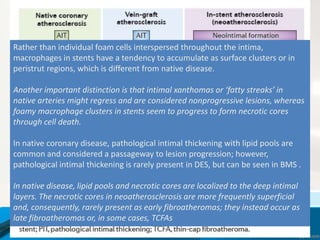 Rather than individual foam cells interspersed throughout the intima,
macrophages in stents have a tendency to accumulate as surface clusters or in
peristrut regions, which is different from native disease.
Another important distinction is that intimal xanthomas or ‘fatty streaks’ in
native arteries might regress and are considered nonprogressive lesions, whereas
foamy macrophage clusters in stents seem to progress to form necrotic cores
through cell death.
In native coronary disease, pathological intimal thickening with lipid pools are
common and considered a passageway to lesion progression; however,
pathological intimal thickening is rarely present in DES, but can be seen in BMS .
In native disease, lipid pools and necrotic cores are localized to the deep intimal
layers. The necrotic cores in neoatherosclerosis are more frequently superficial
and, consequently, rarely present as early fibroatheromas; they instead occur as
late fibroatheromas or, in some cases, TCFAs
 