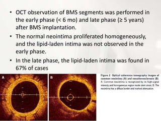 • OCT observation of BMS segments was performed in
the early phase (< 6 mo) and late phase (≥ 5 years)
after BMS implantation.
• The normal neointima proliferated homogeneously,
and the lipid-laden intima was not observed in the
early phase.
• In the late phase, the lipid-laden intima was found in
67% of cases
 