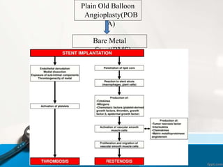 Plain Old Balloon
Angioplasty(POB
A)
Bare Metal
Stent(BMS)
 