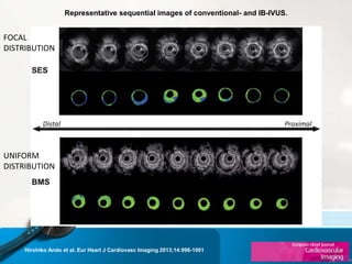 Representative sequential images of conventional- and IB-IVUS.
Hirohiko Ando et al. Eur Heart J Cardiovasc Imaging 2013;14:996-1001
FOCAL
DISTRIBUTION
UNIFORM
DISTRIBUTION
 
