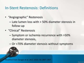 In-Stent Restenosis: Definitions
• “Angiographic” Restenosis
– Late lumen loss with > 50% diameter stenosis in
follow-up
• “Clinical” Restenosis
– Symptom or ischemia recurrence with >50%
diameter stenosis,
– Or >70% diameter stenosis without symptoms
Modified from Dangas et al. JACC 2010; 56:1897-1907
 