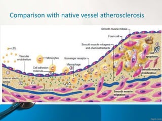 COMPARISON
• In contrast to the decades that it takes for atherosclerosis
to develop in native coronary disease,in-stent
n...