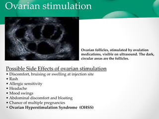 In vitro fertilization | PPTX