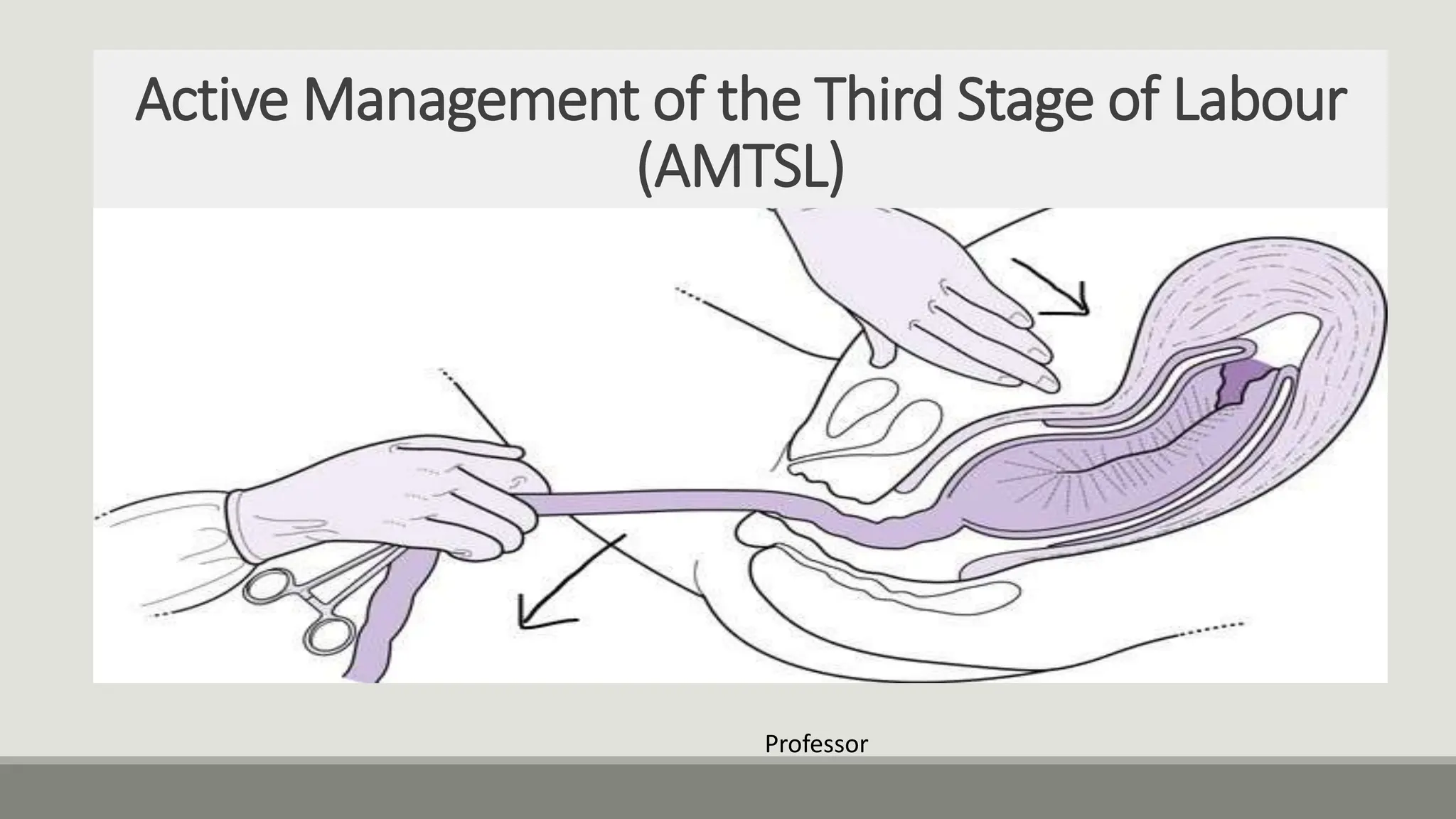Active management of third stage of labo | PPTX