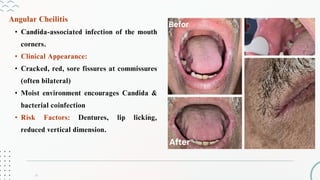 Over veiw of Oral Candidal infections.pdf