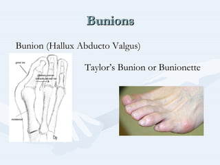 BunionsBunionsBunions
Bunion (HalluxBunion (Hallux AbductoAbducto Valgus)Valgus)
Taylor’s Bunion or Bunionette
 