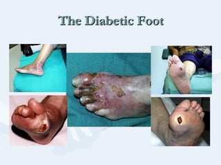 The Diabetic FootThe Diabetic FootThe Diabetic Foot
 