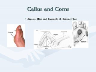 Callus and CornsCallus and CornsCallus and Corns
•• Areas at Risk and Example of Hammer ToeAreas at Risk and Example of Hammer Toe
 