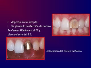 • Aspecto inicial del pte.
• Se planeo la confección de corona
In Ceram Alúmina en el 21 y
clareamiento del 22.
Colocación del núcleo metálico
 