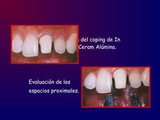 Prueba del coping de In
Ceram Alúmina.
Evaluación de los
espacios proximales.
 