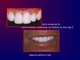Instalación de la corona de In
Ceram Alúmina, cementada con fosfato de Cinc tipo I
Aspecto estético final
 