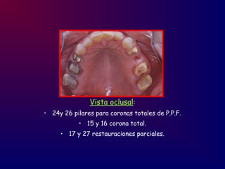 Vista oclusal:
• 24y 26 pilares para coronas totales de P.P.F.
• 15 y 16 corona total.
• 17 y 27 restauraciones parciales.
 