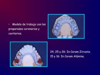 • Modelo de trabajo con los
preparados coronarios y
cavitarios.
24, 25 y 26: In Ceram Zirconio.
15 y 16: In Ceram Alúmina.
 