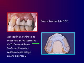 Prueba funcional de P.P.F.
Aplicación de cerámica de
cobertura en los sustratos
de In Ceram Alúmina,
In Ceram Zirconio y
restauraciones onlays
en IPS Empress 2
 