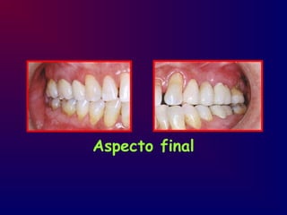 Aspecto final
 