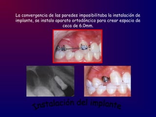 La convergencia de las paredes imposibilitaba la instalación de
implante, se instalo aparato ortodóncico para crear espacio de
ceca de 6.0mm.
 