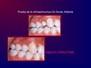 Prueba de la infraestructura In Ceram Alúmina
Aspecto clínico final.
 