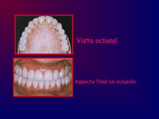 • Vista oclusal
• Aspecto final en oclusión
 