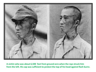 A victim who was about 6,500 feet from ground zero when the rays struck him
from the left. His cap was sufficient to protect the top of his head against flash burns.
 