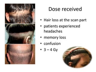 Dose received
• Hair loss at the scan part
• patients experienced
headaches
• memory loss
• confusion
• 3 – 4 Gy
 