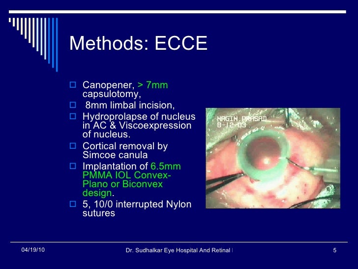 Incidence of posterior capsular opacification in rigid pmma