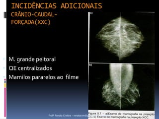 INCIDÊNCIAS ADICIONAIS
   CRÂNIO-CAUDAL-
   FORÇADA(XXC)




 M. grande peitoral
 QE centralizados
 Mamilos pararelos ao filme




                 Profª Renata Cristina - renatacvm@gmail.com - 96984689
 
