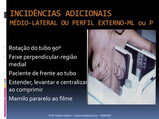 INCIDÊNCIAS ADICIONAIS
  MÉDIO-LATERAL OU PERFIL EXTERNO-ML ou P


 Rotação do tubo 90º
 Feixe perpendicular-região
  medial
 Paciente de frente ao tubo
 Estender, levantar e centralizar
  ao comprimir
 Mamilo pararelo ao filme

                  Profª Renata Cristina - renatacvm@gmail.com - 96984689
 