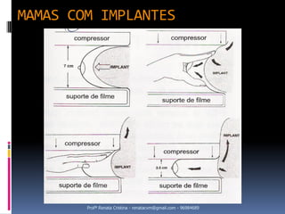 MAMAS COM IMPLANTES




        Profª Renata Cristina - renatacvm@gmail.com - 96984689
 
