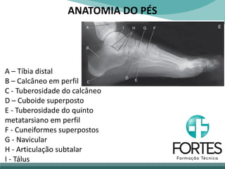 ANATOMIA DO PÉS
A – Tíbia distal
B – Calcâneo em perfil
C - Tuberosidade do calcâneo
D – Cuboide superposto
E - Tuberosidade do quinto
metatarsiano em perfil
F - Cuneiformes superpostos
G - Navicular
H - Articulação subtalar
I - Tálus
 